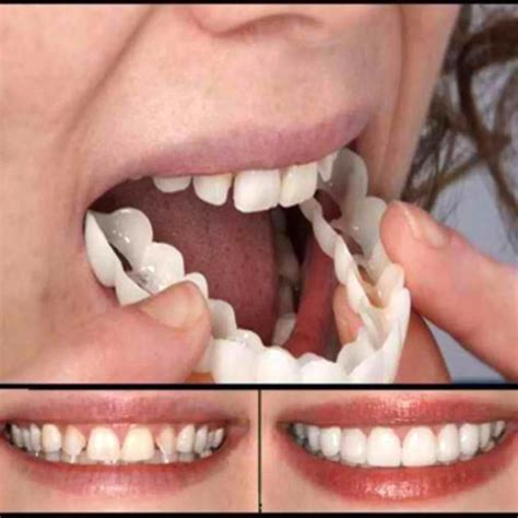 Magic teeth brace instant smile veneers